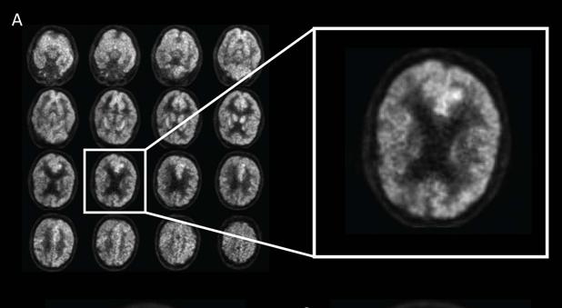 alzheimer-radiology-kMNG--620x349@abc