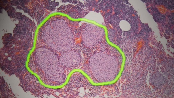 microscopio-realidad-aumentada-google-inteligencia-artificial-tumores