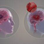 VACUNA ASTRAZENECA Así se pueden evitar los trombos en el cerebro