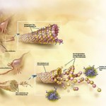 La enfermedad de Alzheimer podría estar provocada por infecciones fúngicas