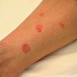 ¿Manchas rojas en la piel?: conocé las seis causas más frecuentes
