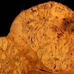 Estudio: Las bebidas alcohólicas son responsables del cáncer de hígado más letal