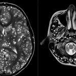 Acude al hospital con un fuerte dolor de cabeza y le hallan una plaga de larvas en el cerebro