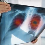 Descubren que la comida chatarra puede elevar el riesgo de sufrir este tipo de cáncer