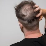 Descubren una proteína que nos protege de la calvicie