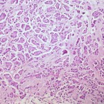MARCADOR PARA DETECTAR CÁNCER DE MAMA UN AÑO ANTES QUE MÉTODOS ACTUALES