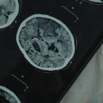 Por qué la diabetes tipo 2 cambia el cerebro de un modo similar al Alzheimer