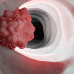 UNA PROMETEDORA TERAPIA CONTRA EL CÁNCER PROVOCA QUE LOS TUMORES SE ATAQUEN A SÍ MISMOS