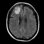 Una mujer tenía un gusano en el cerebro nunca antes encontrado en humanos