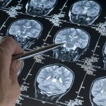 Una pista en la mediana edad indica que es probable que padezcas alzhéimer dentro de 20 años
