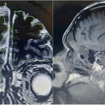 Acude al médico por un goteo nasal y descubre que en realidad es una fuga de líquido cerebral