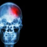 Apuesta de la ciencia: las terapias psiquiátricas que podrían ayudar a la curación del cerebro después de un ACV