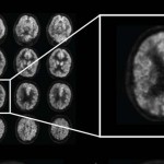 La inteligencia artificial detecta precozmente el alzhéimer.