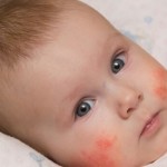 Dermatitis atópica y estrés: ¿cómo se relacionan?
