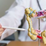 Estos sencillos cambios en la dieta reducen el riesgo de cáncer de colon