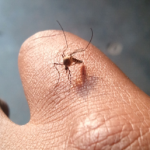 ¿Cómo evitar la comezón de un piquete de mosquito?