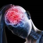 Conoce los síntomas de una conmoción cerebral