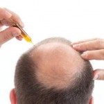 El fármaco para la dermatitis atópica que hace crecer el pelo