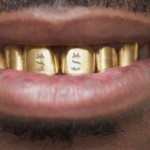 Los peligros ocultos de los dientes de oro.