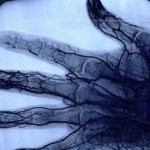 Esta es la inquietante radiografía de los dedos de un profesional del yo-yo tras 26 años de uso diario