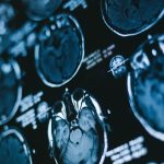 Decodifican lo que pasa en el cerebro poco antes de morir