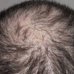 Un nuevo suero capilar realmente hace crecer el pelo en dos semanas, dice un estudio
